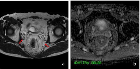 T2 And Dwi Mri Examinations Showed Pelvic Lymph Node Swelling Red