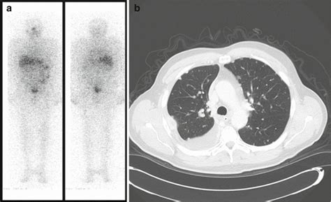 Management Of Distant Metastases In Differentiated Thyroid Cancer