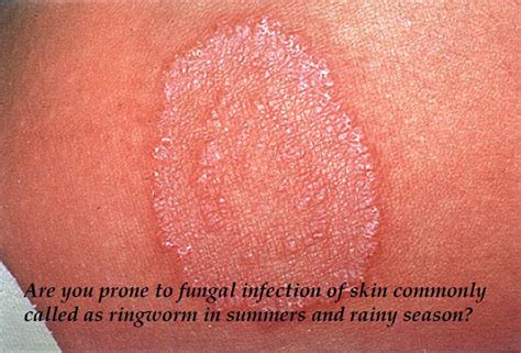 Ring Worm Or Fungal Infection Keep Your Folds Dry Fungal Infection