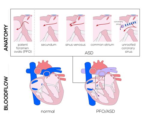 An unroofed coronary sinus is the least common type of atrial septal defect (<1%). Congenital Defects Tutorial - Congenital Heart Defects ...