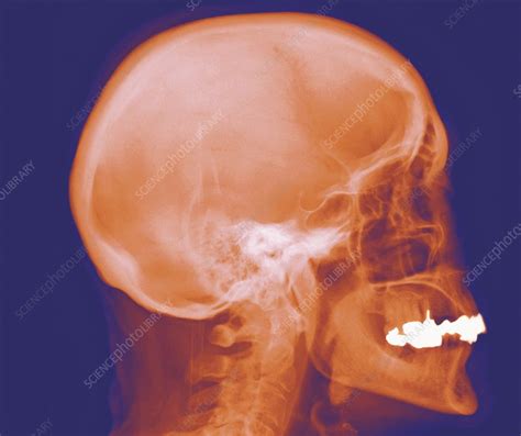 Normal Skull X Ray Stock Image F0013000 Science Photo Library