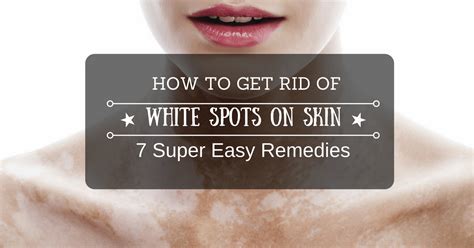 How To Get Rid Of White Spots On Skin 7 Super Easy Remedies Skin