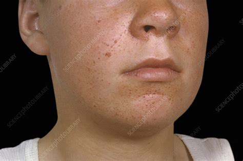 Skin Lesions In Tuberous Sclerosis Stock Image C0542526 Science