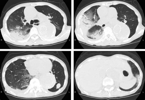 Chest Computed Tomography Showing Consolidation With Air Bronchograms