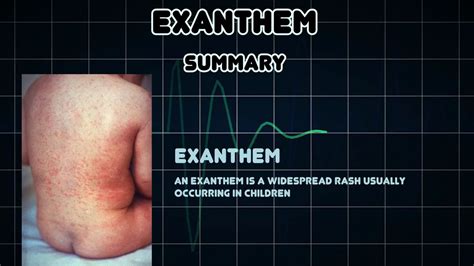 Exanthem Medical Condition Youtube