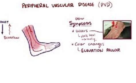 Pad Vs Pvd Peripheral Arterial Disease Vs Peripheral Venous Disease