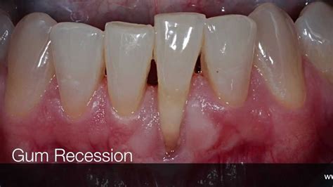 Gum Recession Surgical Treatment Youtube