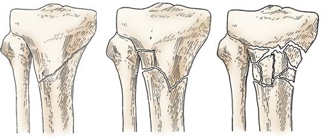 Tibial Plateau Fractures Proximal Tibia Fractures My Xxx Hot Girl