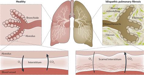 Pathogenesis Of Idiopathic Pulmonary Fibrosis