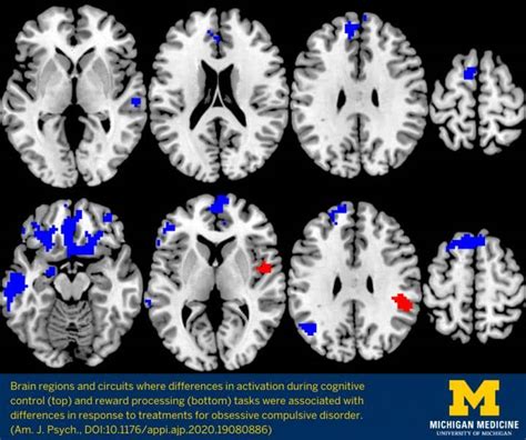 Neuroimaging Shows Which Ocd Treatment Works Best Axis Imaging News