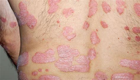 Other Conditions Likely In Psoriasis Patients The Clinical Advisor
