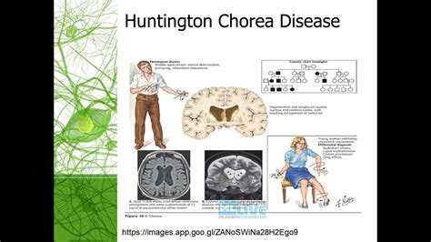Huntington Chorea Disease A Neuro Degenrative Genetic Disease Youtube