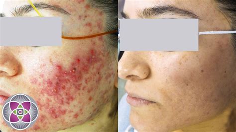 Laser Treatment To Get Rid Of Acne And Acne Scars Youtube
