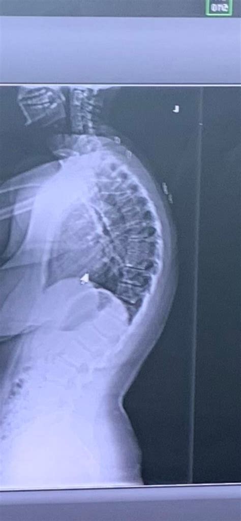 Before And After Spinal Fusion R Xrayporn