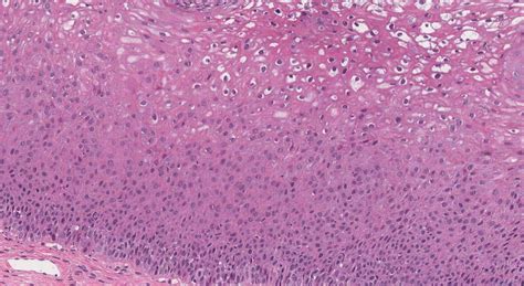 Low Grade Squamous Intraepithelial Lesion Of The Cervix Atlas Of