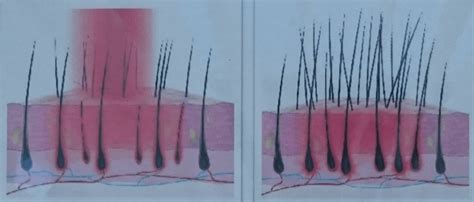 These photons are absorbed by weak cells to encourage hair growth. Laser hair loss treatment - Total Hair Loss Solutions