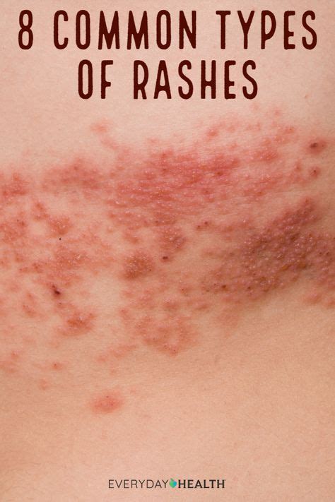 Common Types Of Rashes And What They Look Like Skin Rashes Pictures