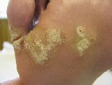 Learn how to remove wart on finger. Verrucae & Hand Warts