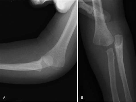 Preoperative Radiographs A B Of The Right Elbow In Case 1 Showing