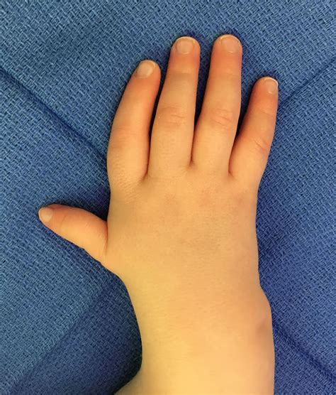Thumb Deformity Congenital Hand And Arm Differences