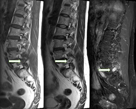 Osteoid Osteoma On The Way Of Pedicle Screw Insertion For Spinal Fusion