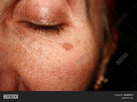 Brown Spots Under Eye Image And Photo Free Trial Bigstock