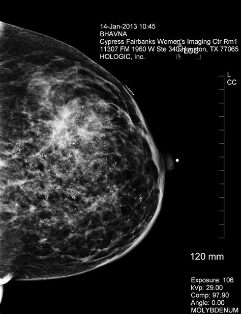 Cancer Chronicles Mammogram And Ultrasound