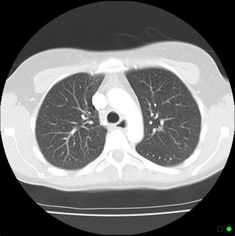 Normal Chest Ct Loading Stack 0 Images Remaining Chest Case Lunges