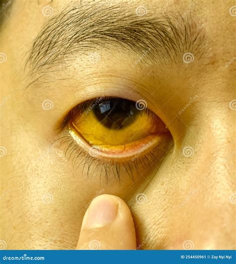 Deep Jaundice Of Eye In Asian Male Patient Yellowish Discoloration Of