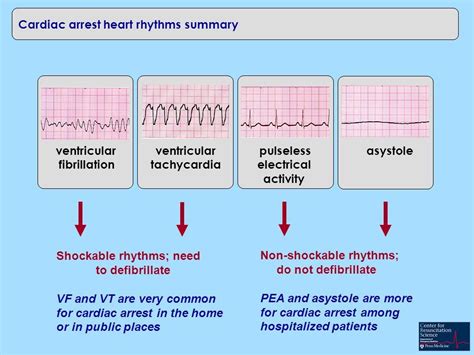 Implantable Cardioverter Defibrillator Cardiac Rhythms Heart Rhythms