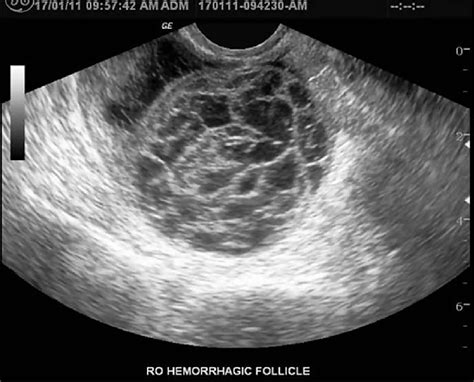 E Transvaginal Usg Depicts Typical Features Of Hemorrhagic Follicular
