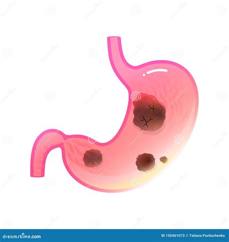 Vector Isolated Illustration Of Stomach Cancer Stock Vector