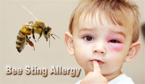 Bee Sting Allergy Causes And Cures Health Synonyms