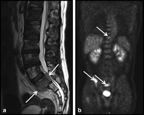 Sclerotic Lesions Of The Spine MRI Assessment Mugera 2013