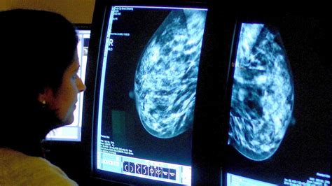 Ai System Can Detect Breast Cancer Better Than Clinical Experts Study