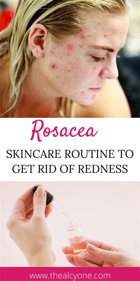 Rosacea Causes Triggers And Skincare Routine For Rosacea Artofit