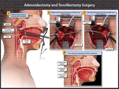 Adenoidectomy And Tonsillectomy Surgery Trialexhibits Inc