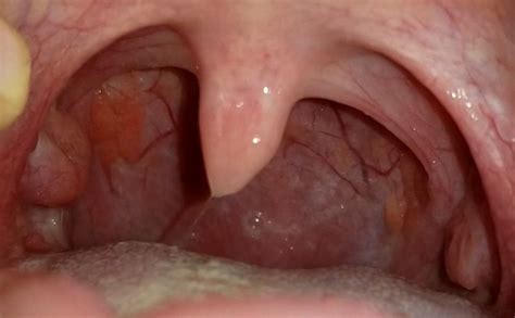 I Have An Enlarged Tonsil With Bumps On The Side Of The Tongue The