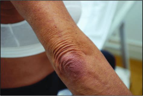 Elbow Wrinkles Before Fibrogel Injection Download Scientific Diagram