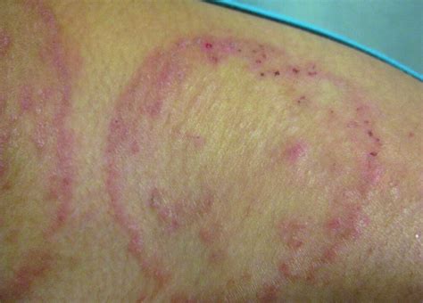 Body Ringworm Tinea Corporis Skin Disorders