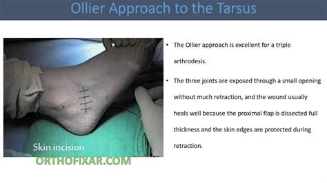 Ollier Approach To Sinus Tarsi