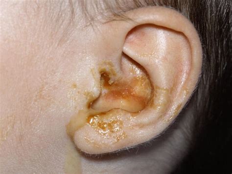 Tips On The Causes And Preventions Of Ear Pus Health Gadgetsng