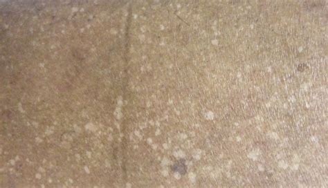 épingle Graisse Image White Spots On Legs La Tour évasion De La Prison