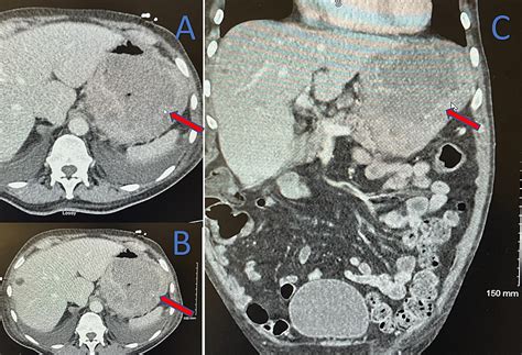 Cureus Giant Dedifferentiated Gastric Liposarcoma Largest To Date