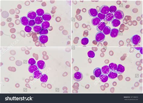 The nuclei of two polymorphonuclear leukocytes white blood cells. Leukemia Human Blood Cell Under Microscope Stock Photo ...