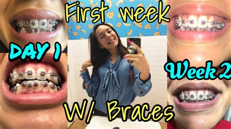 Tips To Surviving 1st Week Wbraces Photos Youtube