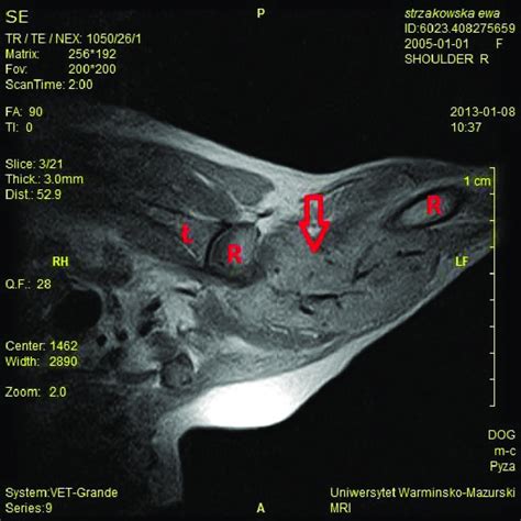 T2 Weighted Spin Echo Sequence Image In Sagittal Plane The Presence Of