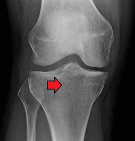 Fracture Of The Proximal Tibia An T M