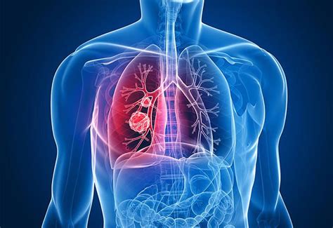 9 Warning Signs Of Lung Cancer You Might Ignore Upbang Lifestyle