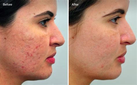 Laser Skin Resurfacing For Acne Scars Efficacy Before And Afters Cost
